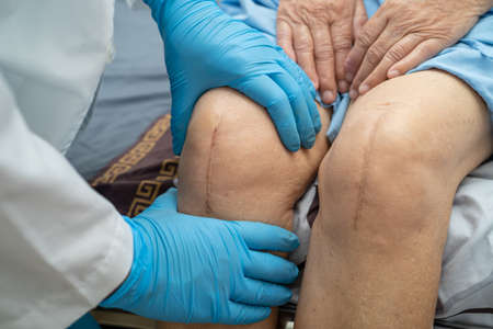 Asian senior or elderly old lady woman patient show her scars surgical total knee joint replacement...