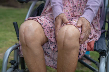 Asian senior or elderly old lady woman patient show her scars surgical total knee joint replacement...