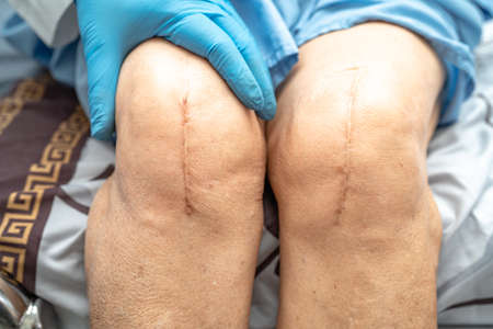 Asian doctor inject Hyaluronic acid platelet rich plasma into the knee of senior woman to walk without pain.の写真素材