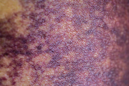 Asian woman dark bruise on the buttocks from a slip accident in the bathroom, close up view.