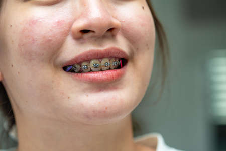 Braces in teenage girl mouth to treat and beauty for increase confidence and good personality.の写真素材