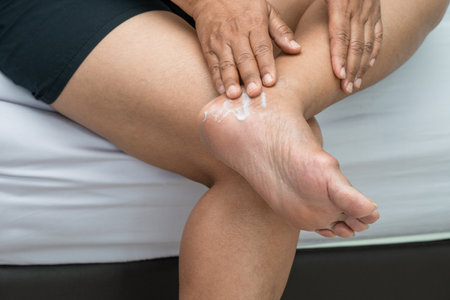 Woman care feet with cracked and dry heel skin cream at home.