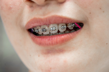 Braces in teenage girl mouth to treat and beauty for increase confidence and good personality.の写真素材