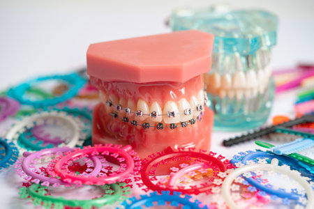 Orthodontic ligatures rings and ties, elastic rubber bands on orthodontic braces, model for dentist...