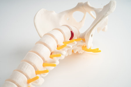 Lumbar spine displaced herniated disc fragment, spinal nerve and bone. Model for treatment medical...