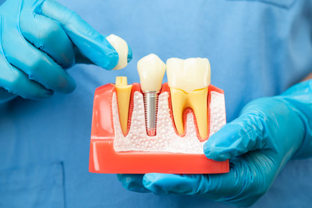 Asian dentist holding dental implant, artificial tooth roots into jaw, root canal of dental...