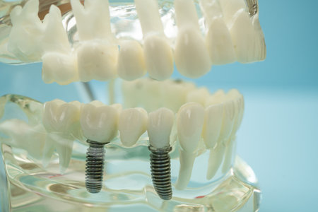Dental implant, artificial tooth roots into jaw, root canal of dental treatment, gum disease, teeth...