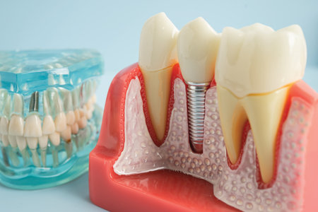 Dental implant, artificial tooth roots into jaw, root canal of dental treatment, gum disease, teeth...