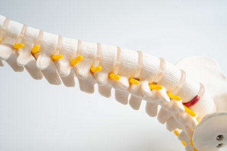 Lumbar spine displaced herniated disc fragment, spinal nerve and bone. Model for treatment medical in the orthopedic department.の写真素材
