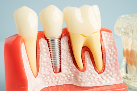 Dental implant, artificial tooth roots into jaw, root canal of dental treatment, gum disease, teeth...