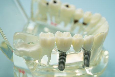 Dental implant, artificial tooth roots into jaw, root canal of dental treatment, gum disease, teeth...