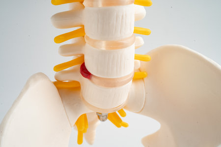 Lumbar spine displaced herniated disc fragment, spinal nerve and bone. Model for treatment medical...