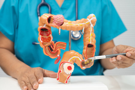 Colorectal cancer, doctor holding intestine colon human model.