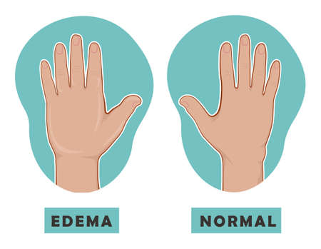 Swollen hand and normal hand. Edema and lymphedema. Vector illustration of the disease before-after.のイラスト素材