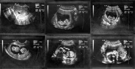 Ultrasound scanning of fetal, black and white photo
