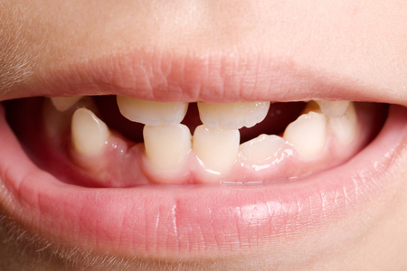 Child missing some front teeth.の写真素材