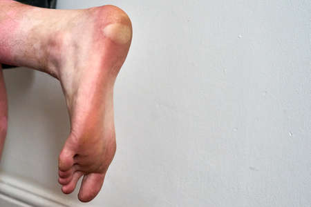 A large blister on the heel and side of a foot