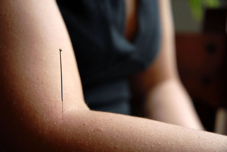 Acupunture: needles in the arm for treatment of the patientの写真素材
