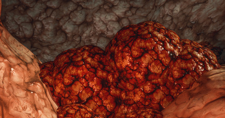 Cancer Cell Oncology concept cancer tumor cyst carcinoma lymphoma colon cancer brest cancers  3d renderingの写真素材