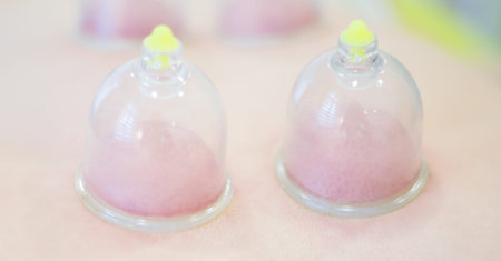 Hijama - the treatment of bloodletting. Attached vacuum cup.