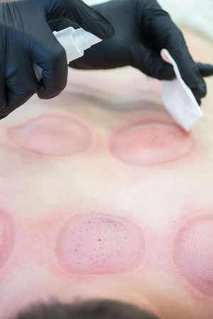 Hijama - the treatment of bloodletting. Cleaning process close up.の写真素材