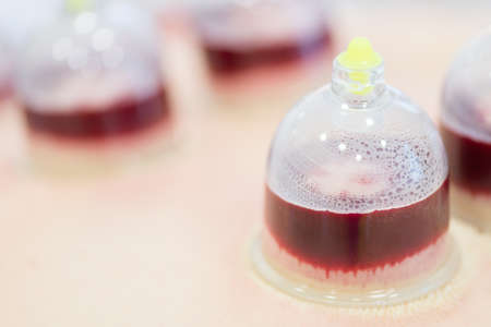 Hijama - the treatment of bloodletting. Attached vacuum cup. Blood fills in the cup.の写真素材