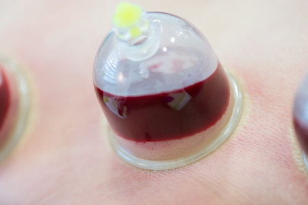 Hijama - the treatment of bloodletting. Attached vacuum cup. Blood fills in the cup.