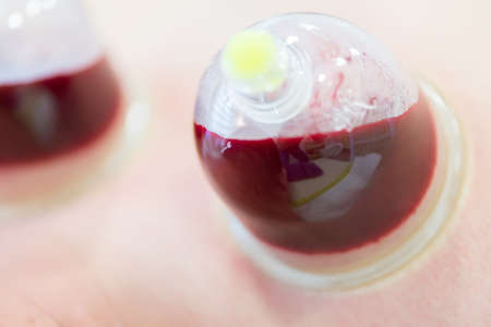 Hijama - the treatment of bloodletting. Attached vacuum cup. Blood fills in the cup.の写真素材