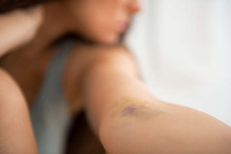 Closeup on drug addict young woman with bruise on handの写真素材