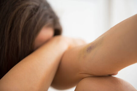 Closeup on bruise hand of drug addict young womanの写真素材