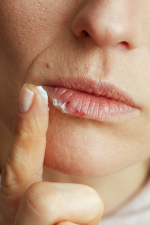 Closeup on 40 years old woman with herpes on lips applying ointment using finger on beige background.の写真素材
