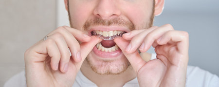 Unrecognizable young latin man adjusting orthodontic silicone trainer or invisible braces aligner....