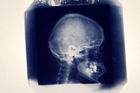 Radiolody image X-ray of adult woman head