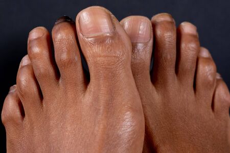 Hammer toe or claw toe of a mixed-race woman in front of black background. Concept for medical...