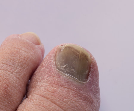 Black and bruised thumb nail. Healthcare and medical concept.の写真素材