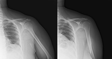 Side by side x-ray photo image showing the left shoulder of a woman.の写真素材