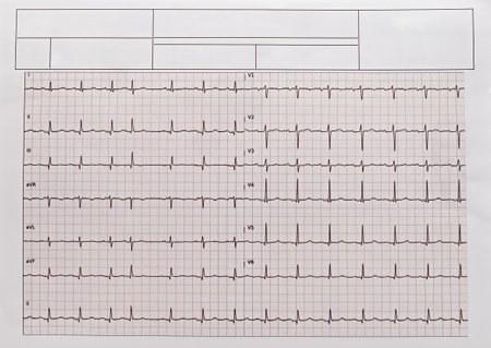 Detailed EKG, ECG, electrocardiogram showing heartbeat patterns.の写真素材
