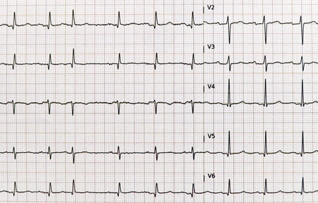 Detailed EKG, electrocardiogram showing heartbeat patterns.の写真素材
