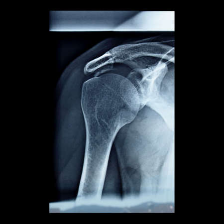 Medical X-Ray imaging of a shoulder, used in diagnostic radiology of skeleton bonesの写真素材