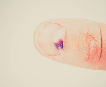 Vintage looking Subungual hematoma - collection of blood underneath fingernail (black toenail) medical condition. Aka runner or tennis toeの写真素材