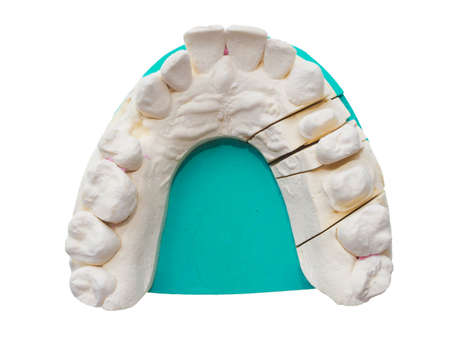 Positive dental mould reproduction cast formed from a negative dental impression of teeth isolated...
