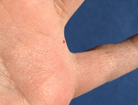 minor bruise with drop of blood on a hand