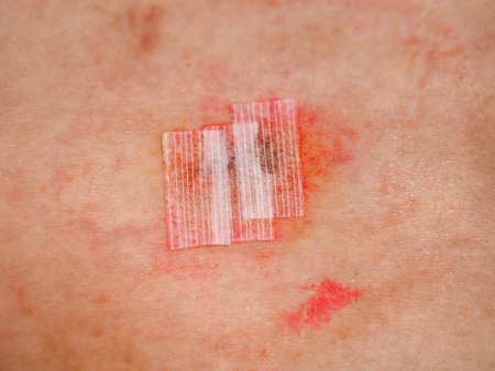 surgical wound with steri strips microporous surgical tape after removal of stitches and antiseptic iodine tinctureの写真素材