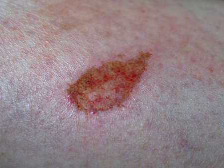 scar tissue following abrasion graze on human limb skinの写真素材