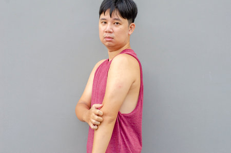 Asian man scratching itch with hand on elbow area, health care conceptの写真素材