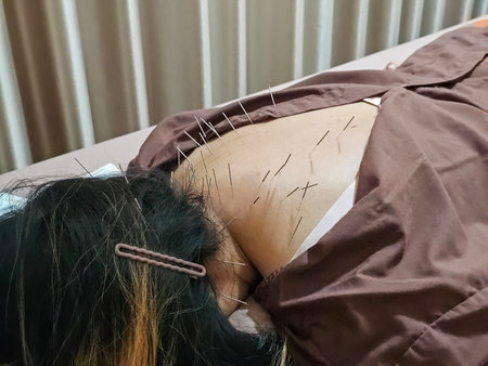 An Asian woman lying face down on her back receiving acupuncture, alleviating back pain and treating muscle injuries. Office Syndromeの写真素材