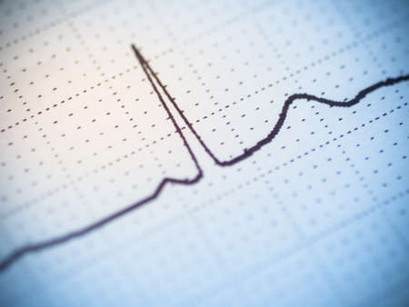Close up of an single beat electrocardiogram analysing for heart disease problem.