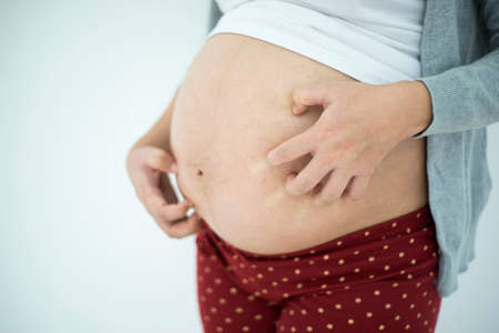 Pregnant woman scratching belly because itchy skinの写真素材