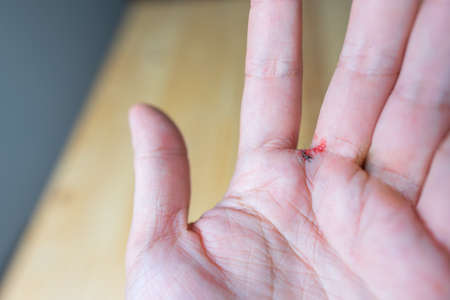 image of hand with mosquito dying and red human blood.の写真素材