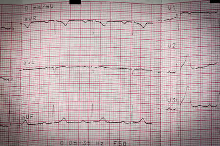 Electrocardiogram ecg heart beat test in paper 